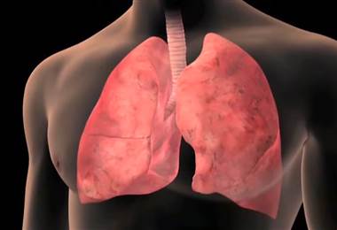 Todo Lo Que Debe Saber Acerca De La Enfermedad Pulmonar Obstructiva
