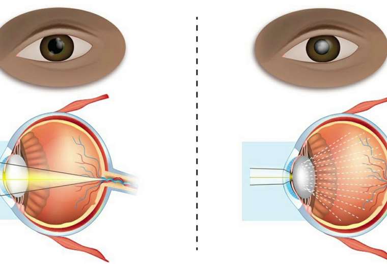 Todo Lo Que Necesita Saber Sobre Las Cataratas En Los Ojos Teletica