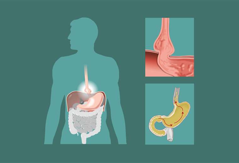 Todo Lo Que Necesita Saber Sobre Las Hernias Hiatales Teletica