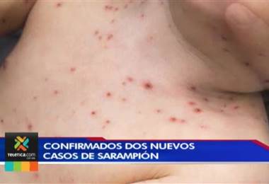 Salud confirma dos casos más de sarampión