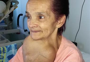 Especialistas del Calderón Guardia extirparon un tumor gigante a una paciente de 66 años