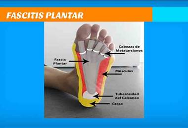 ¿Cómo tratar el dolor en el talón y la planta del pie?