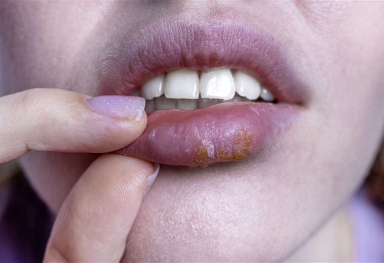 Virus del papiloma humano