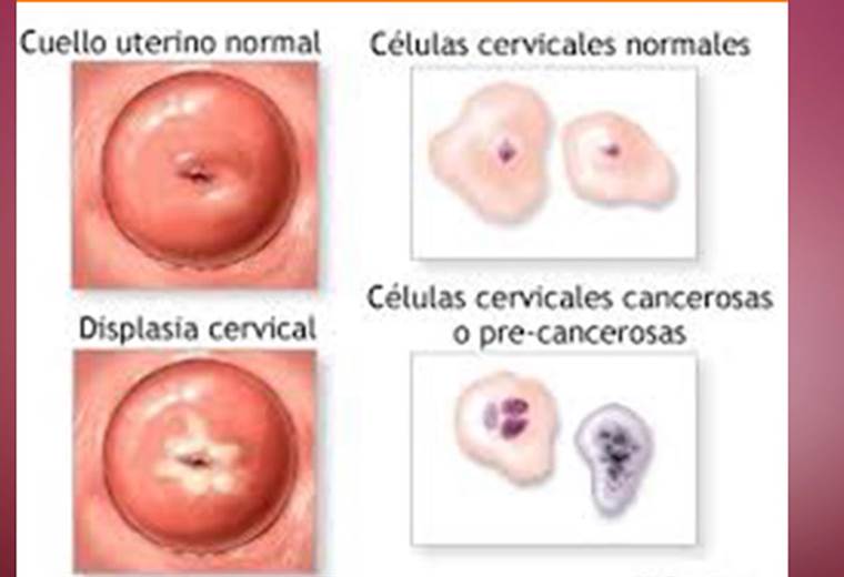 ¿Por qué ocurre la displasia cervical y cuál es su tratamiento?