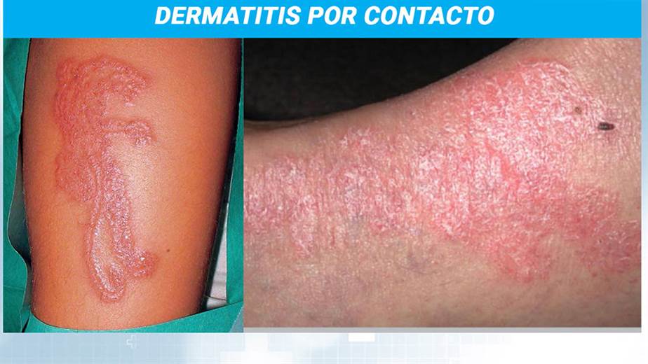 contact dermatitis cold compress