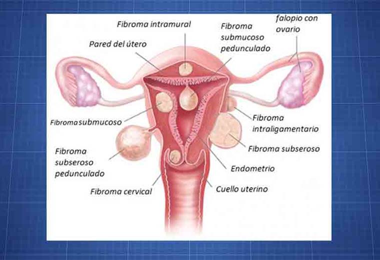 ¿Por qué aparecen los tumores en el útero?
