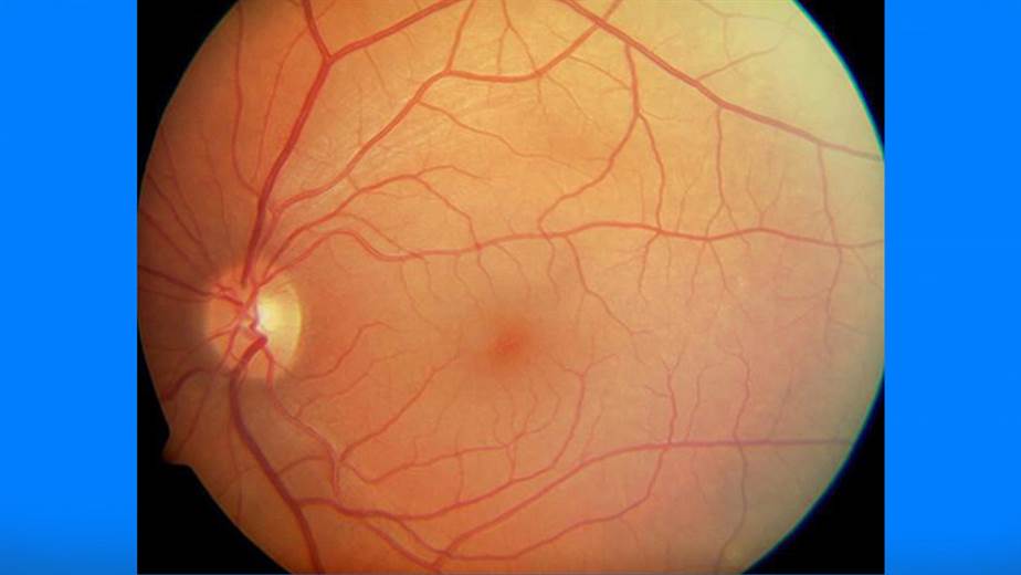 Cuál es la importancia de revisarse el 'fondo de ojo'? | Teletica