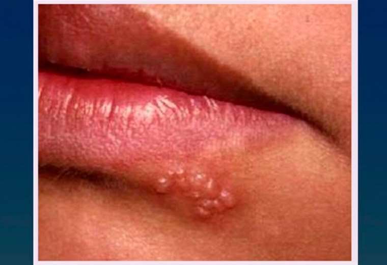 Cmo Tratar El Herpes Labial Teletica