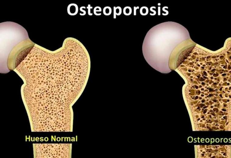 Hablamos Acerca De Fracturas De Cadera Por Osteoporosis Teletica 3800