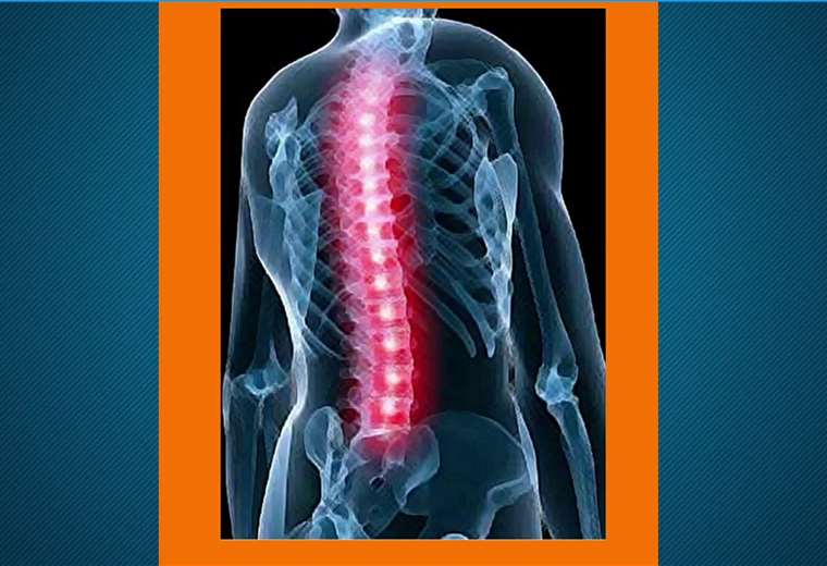 La Espondilitis Anquilosante Es M S Com N De Lo Que Cree Teletica