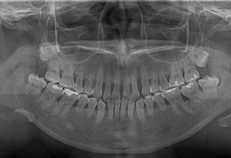 La pérdida del hueso dental, explicada en términos sencillos