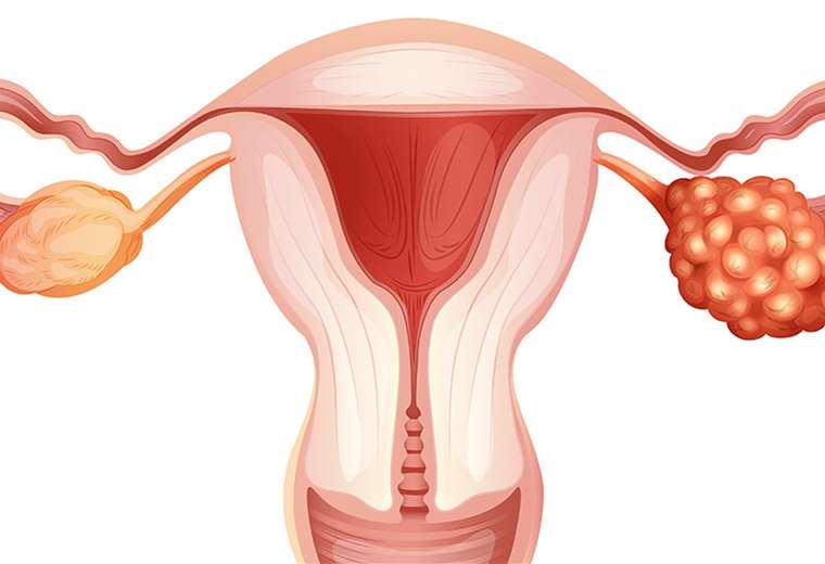 Cáncer de ovario: sus síntomas y posibles tratamientos