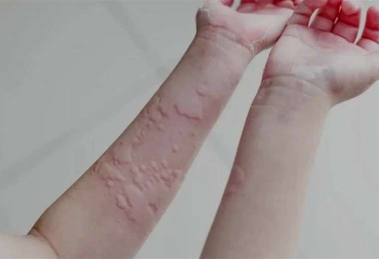Conozca los detonantes de la urticaria y qué hacer ante un brote Teletica