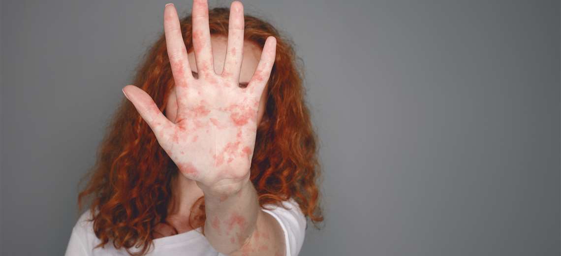 OPS advierte del aumento de casos de sarampión en las Américas