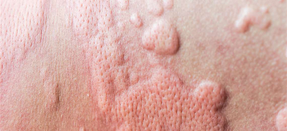 Salud confirma cuarto caso de sarampión: un cartaginés con viaje reciente a Guatemala