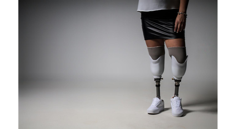 Daryl Cruz, joven que perdió las dos piernas en accidente durante pique