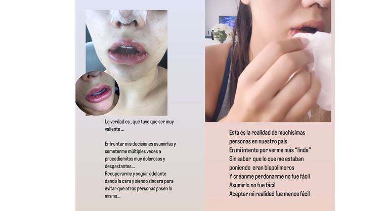 Montserrat del Castillo habla por primera vez sobre las inyecciones de labios