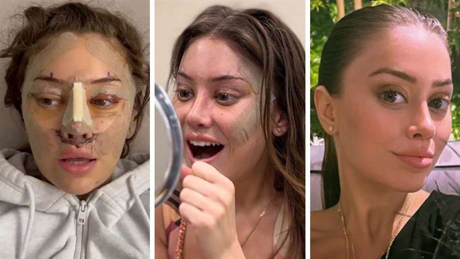 ¿Un “lifting” a los 28? Por qué cada vez hay más jóvenes que recurren a cirugía plástica