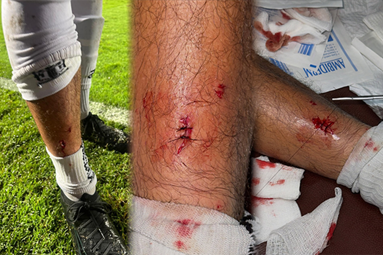 Así quedó la pierna de Kendall Porras tras acción de Celso Borges