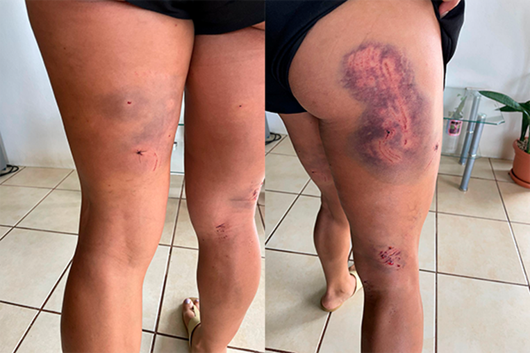 Roxana sufrió graves heridas al ser atacada por perro mientras corría