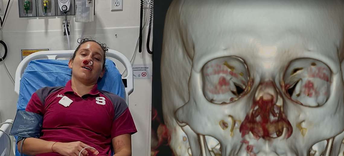 Carolina Venegas muestra cómo quedó su nariz tras su fractura nasal - Imagen de la noticia