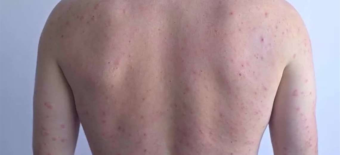 Médicos advierten: un paciente con sarampión puede contagiar hasta 18 personas - Imagen de la noticia