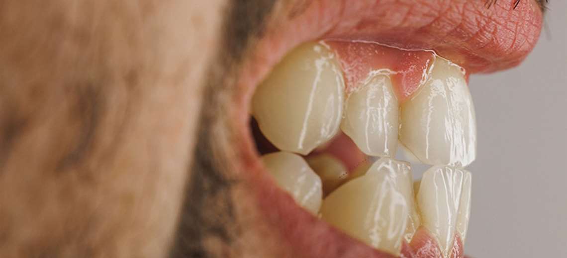 Casi todos la tienen y pocos lo saben: la gingivitis enciende las alarmas - Imagen de la noticia