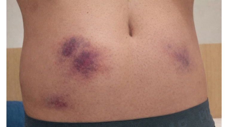 Accidente Pablo Campos en Brasil