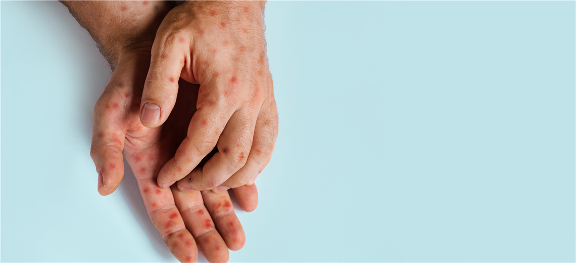 Confirman quinto caso de sarampión en Costa Rica: paciente es de Guanacaste