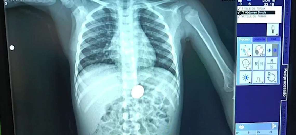 Familia vive angustia: niño traga moneda de ₡10 y es atendido de emergencia