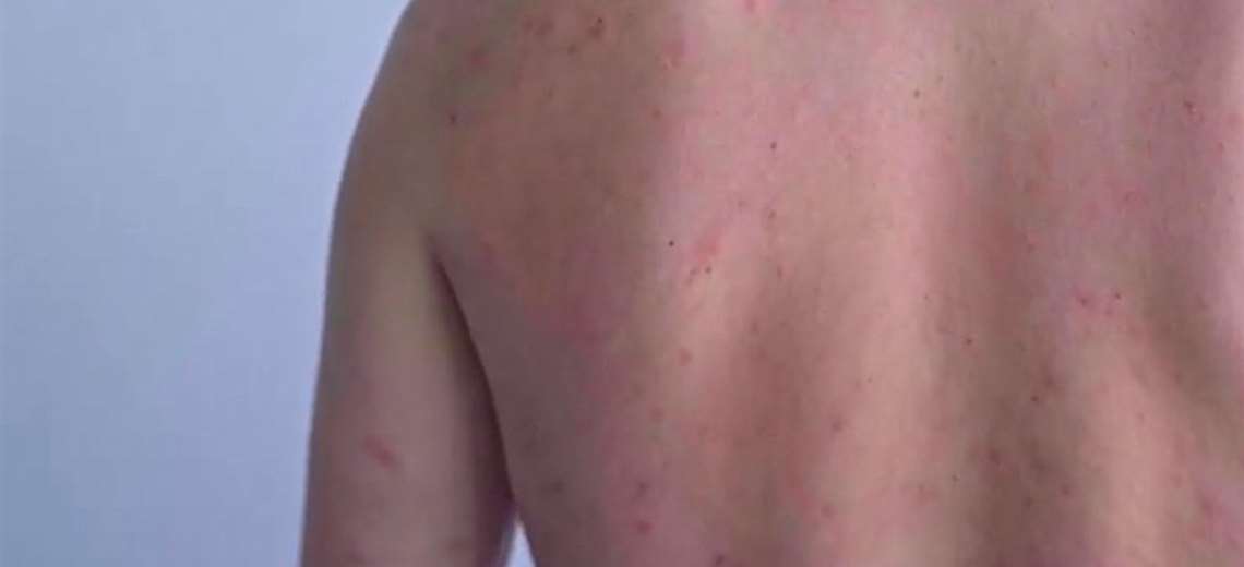 Salud descarta aplicar controles de ingreso a extranjeros por casos de sarampión
