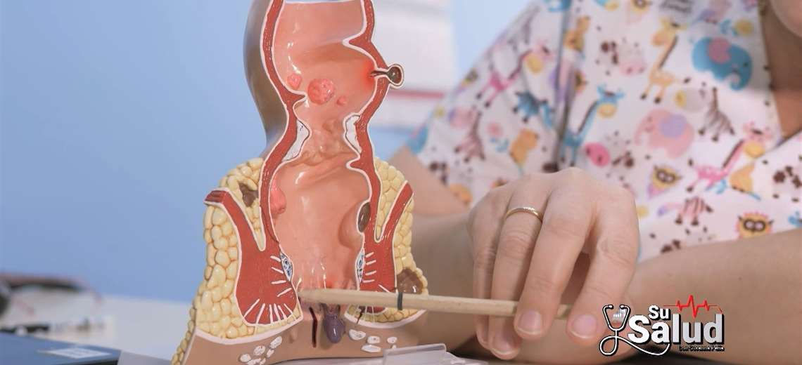 ¿Hay que operar las hemorroides sí o sí? Médico responde pri